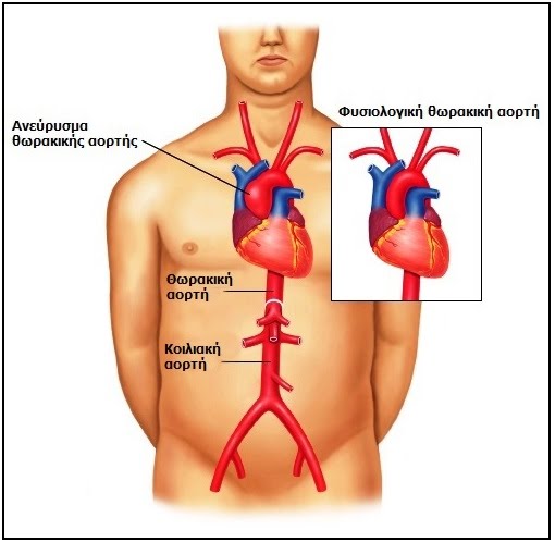 thoracic-aneurysm