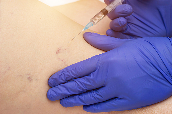 The doctor makes an injection of sclerotherapy in varicose veins, phlebology, close-up, professional