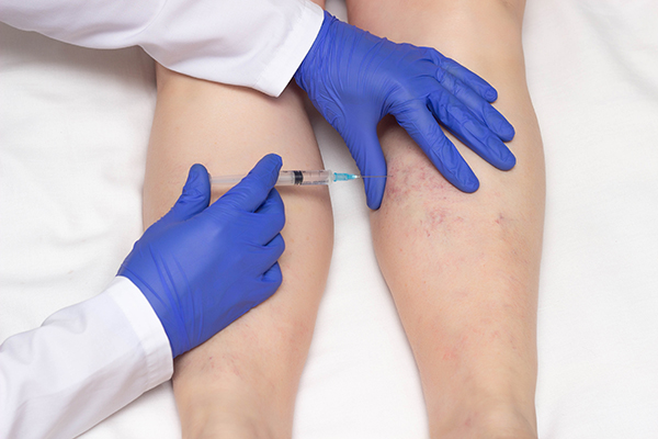 Doctor in medical gloves injects sclerotherapy procedure on the legs of a woman against varicose veins, close-up, ozone therapy, medical