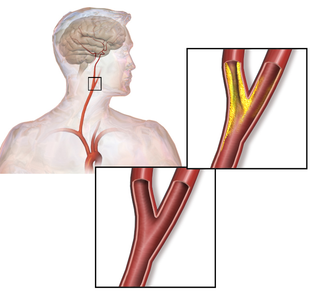 Carotid_artery_stenosis