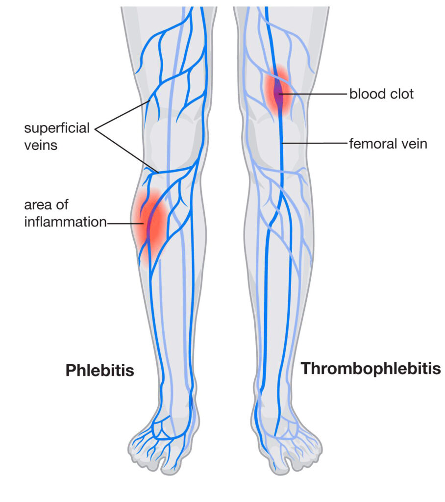 Phlebitis-Graphic