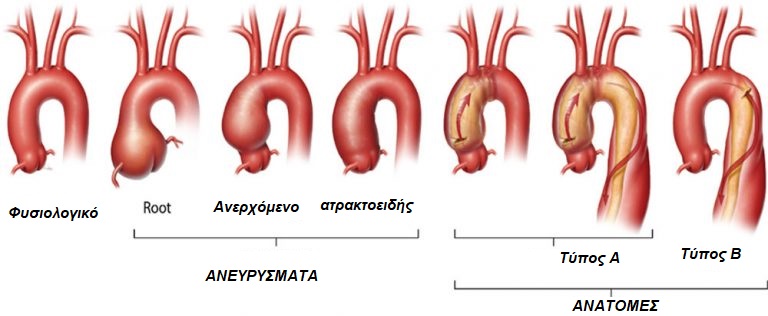 anyrysma-thorakikis-aortis