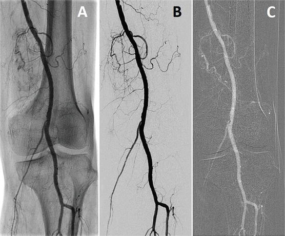 ANGIOGRAPHY PERIPHERAL ARTERY