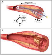 embolectomi peripheral artery