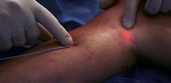 Κιρσοί Θεραπεία με laser από τον αγγειολόγο-αγγειοχειρουργό Ρόκα Γεώργιο στη Ρόδο